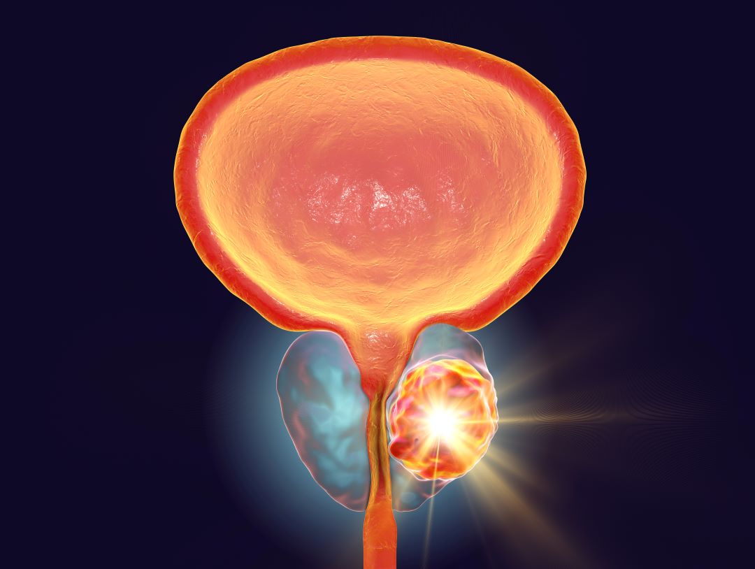 Prostatahyperplasie